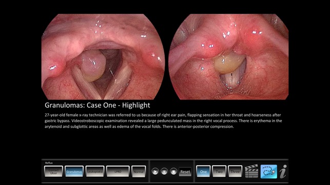 Vocal Pathology: Reflux(圖1)-速報App