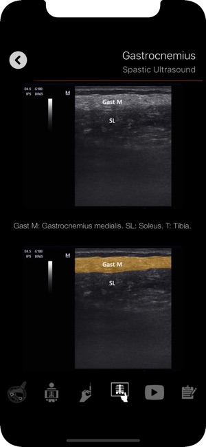 Localización muscular(圖5)-速報App