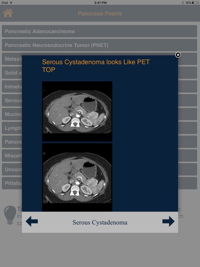 CTisus Pancreatic Tumor Pearls(圖4)-速報App