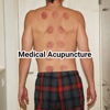 Medical acupuncture