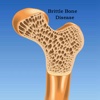 Brittle Bone Disease 101:Research,Symptoms and Treatment
