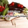 Acne And Removal Techniques