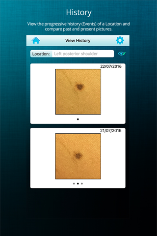 ApreSkin you - track your moles, skin cancers / melanoma and blemishes screenshot 4