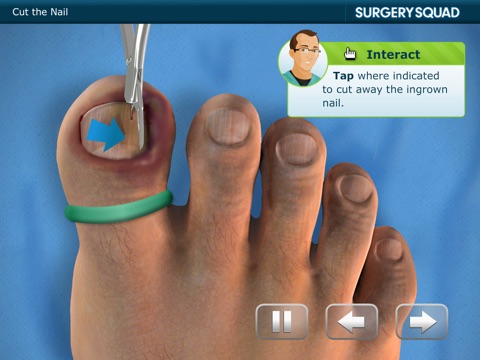 Ingrown Toenail Simulator