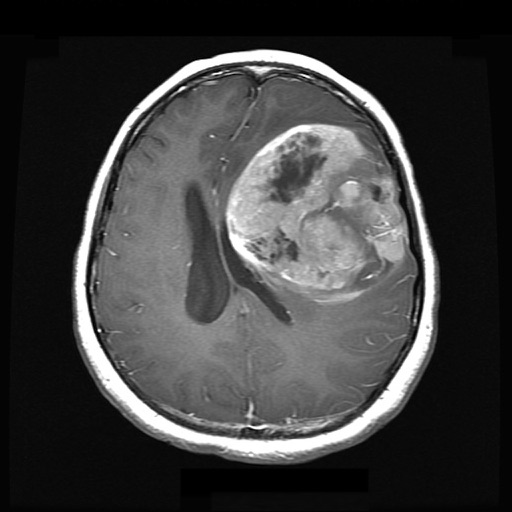 Neuroradiology Flashcards