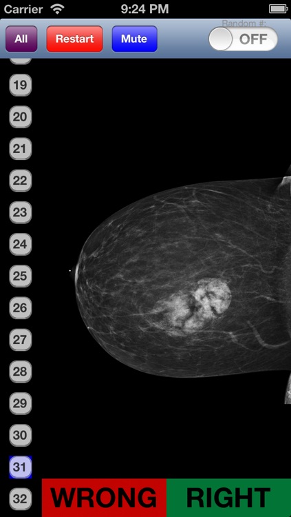 Mammography Flashcards