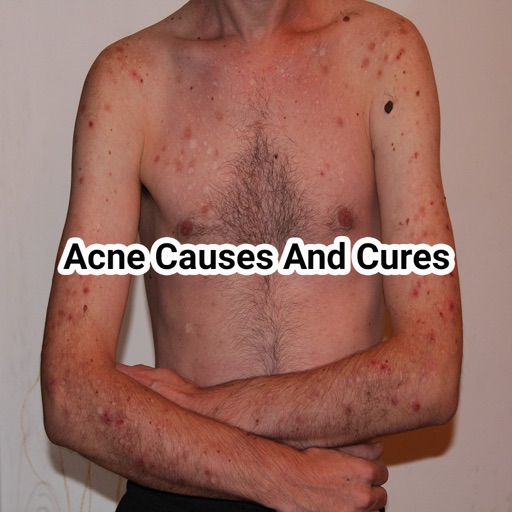 Acne causes and cures icon
