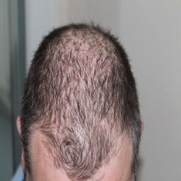Hair Loss Treatment #1 Hair Loss Cure & Care