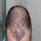 Hair loss is definitely a big problem for both men and women today