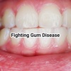 Fighting Gum Disease