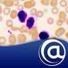 Chronic Lymphocytic Leukemia