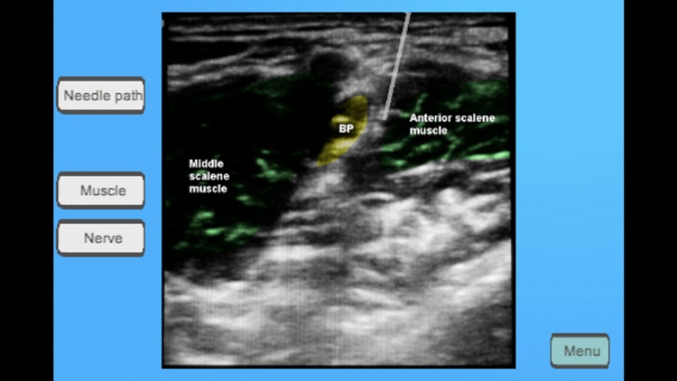 Regional Anesthesia Assistant for iPhone