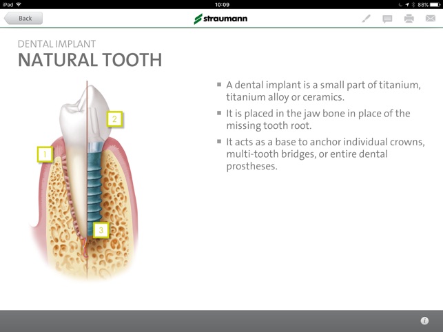 Straumann® Patient Education App(圖2)-速報App