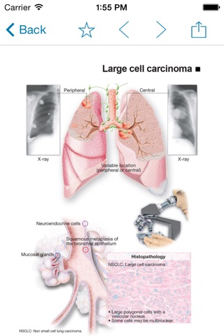 Miniatlas Lung Cancer screenshot 3