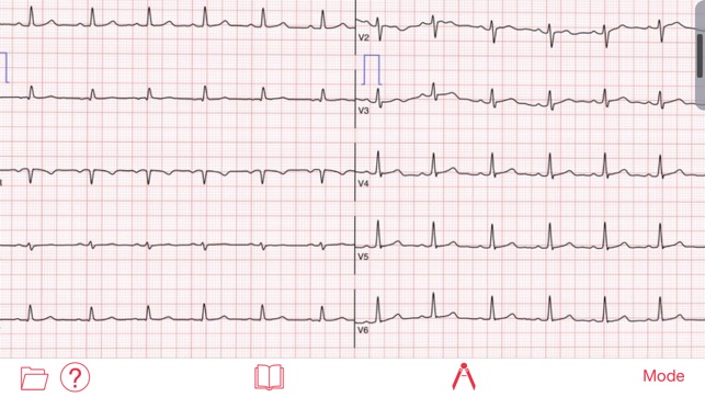 Photo EKG(圖2)-速報App