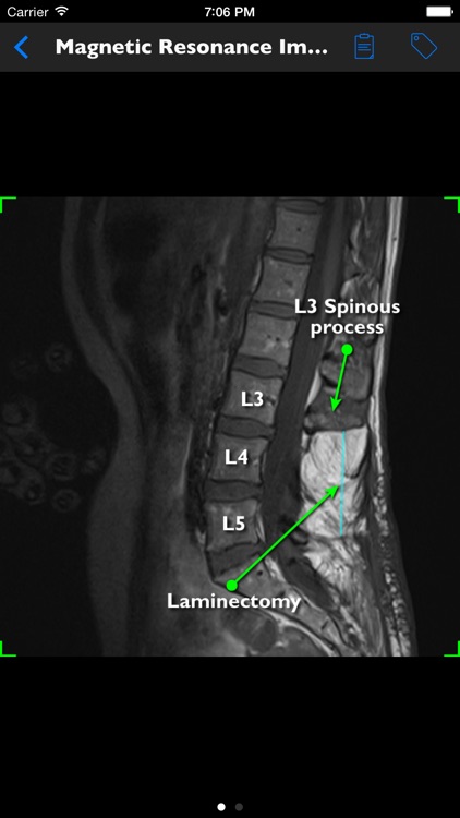mLumbarLaminectomy screenshot-3