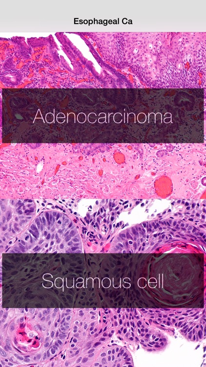 Esophageal Cancer Stage