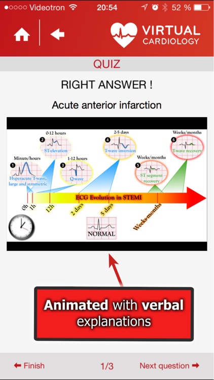 Virtual Cardiology by McGill University cardiologists and cardiologists from Université Laval