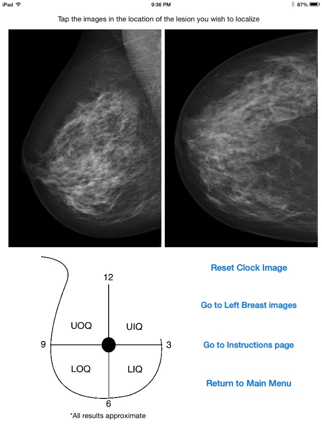 Mammography Localizer(圖1)-速報App