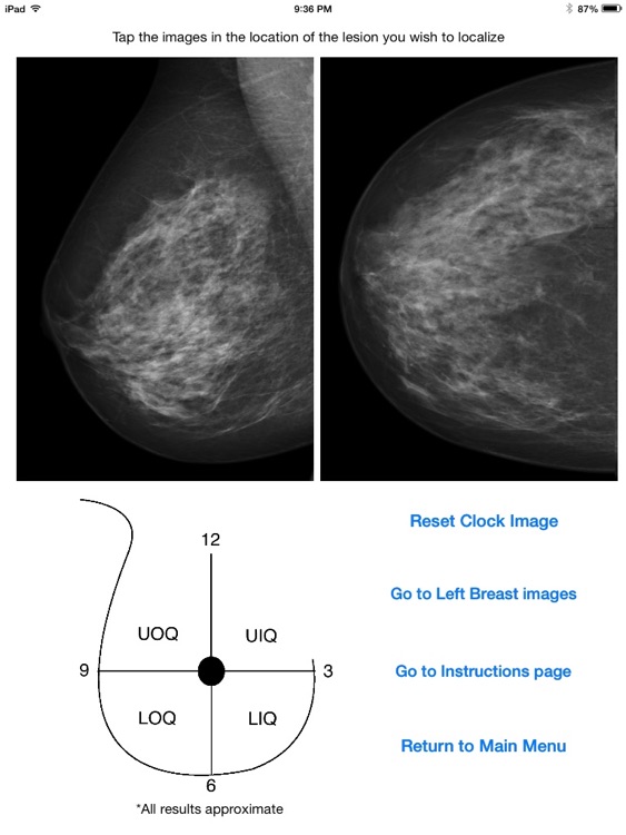 Mammography Localizer