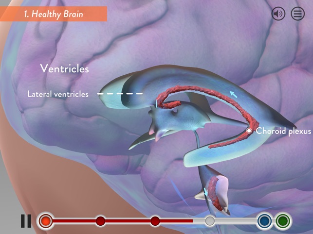 Hydrocephalus Procedure(圖1)-速報App