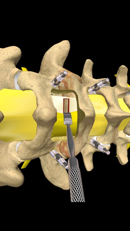 mLumbarPosteriorInterbodyFusionCage