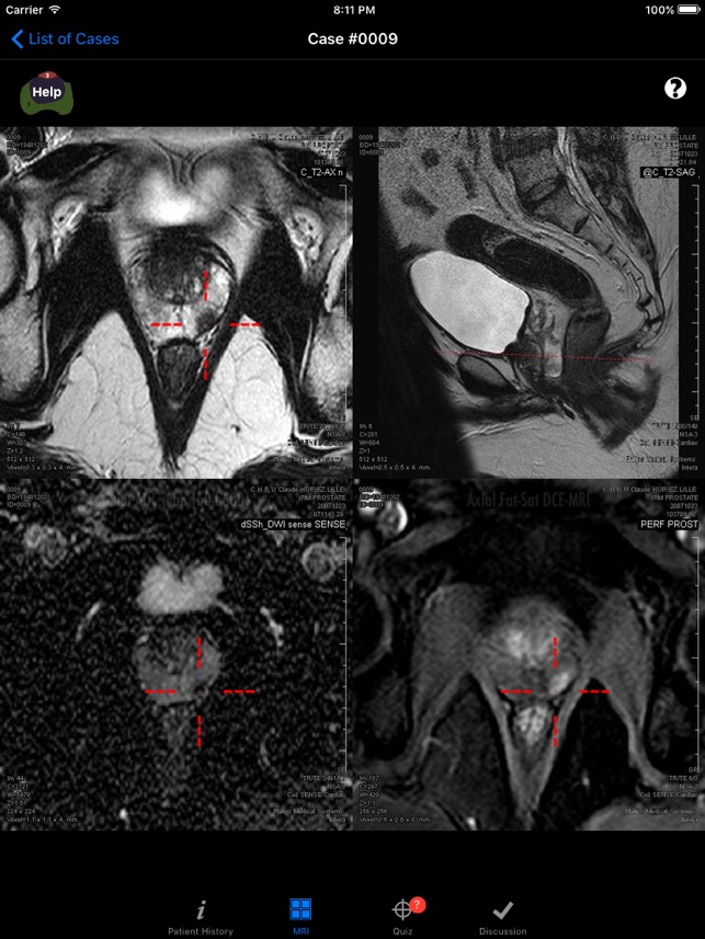 Prostate Cancer Imaging LITE(圖3)-速報App