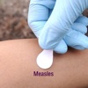 Measles: Guide with Glossary and Top News