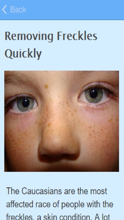 How To Get Rid Of Freckles