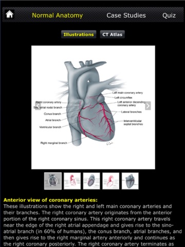 CTisus CT Coronary Arteries screenshot 2