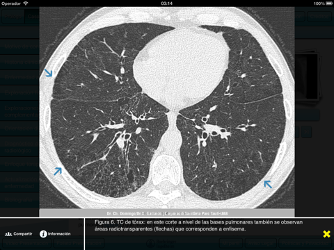 Perlas Clínico Radiológicas del Tórax II screenshot 4