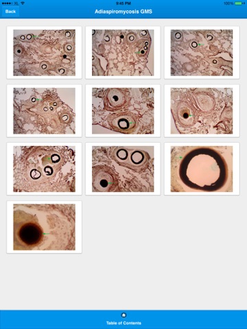 Fungal Infections in Tissues screenshot 2