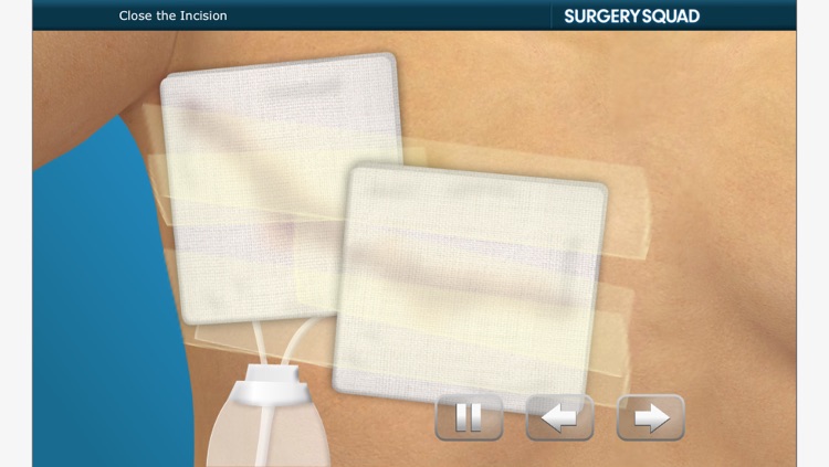 Surgery Squad's Lumpectomy