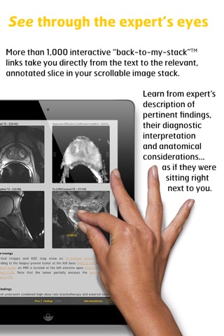 MR Imaging in Prostate Cancer screenshot 4