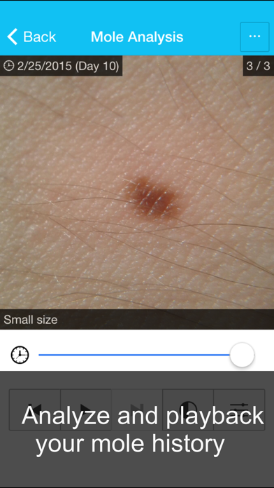 Skin Cancer App - MySkinPal - Map your skin moles Screenshot 3