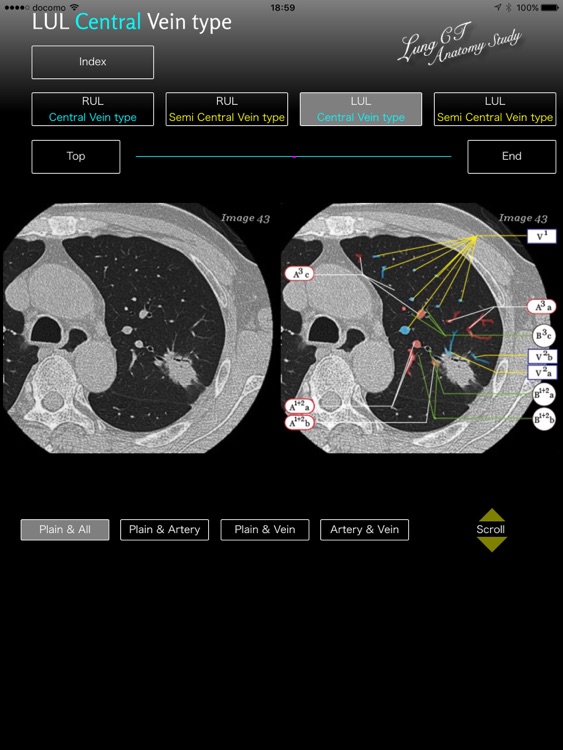 Lung CT Anatomy STUDY screenshot-3