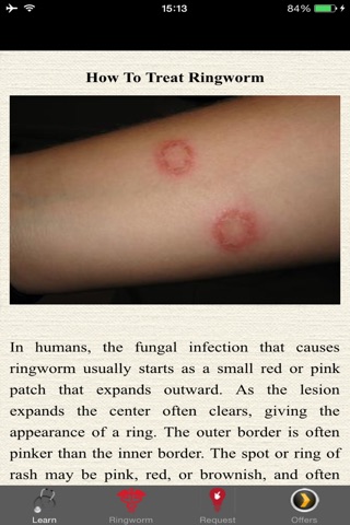 How To Treat Ringworm  -Tips and Suggestions screenshot 2