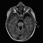 Congenital Central Nervous System Malformations