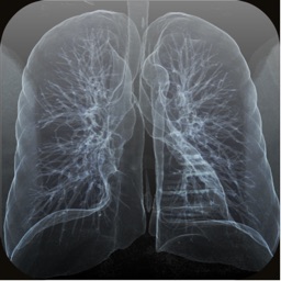 Single Nodule Lung Cancer Screening with Lung-RADS