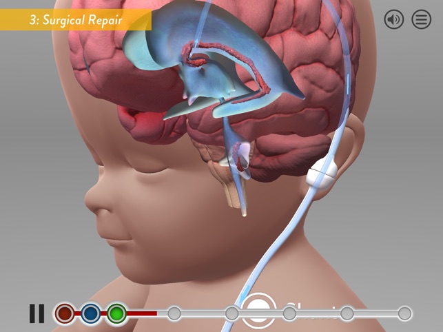 Hydrocephalus Procedure(圖4)-速報App