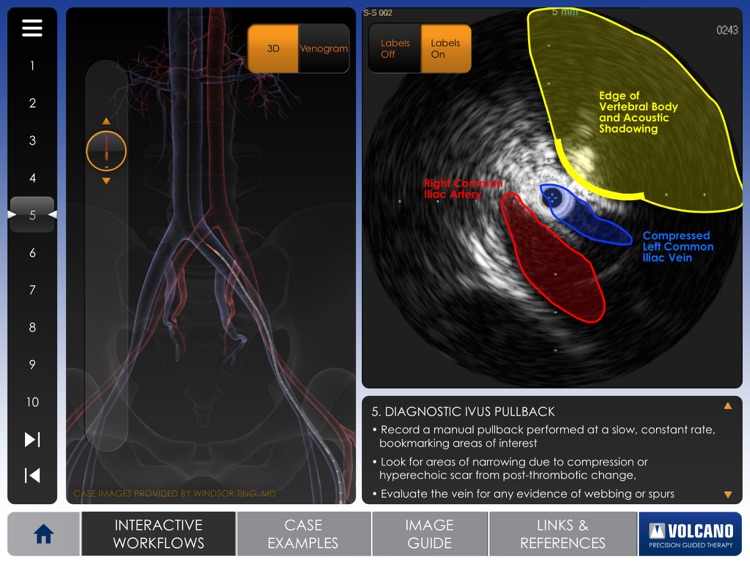 Venous IVUS