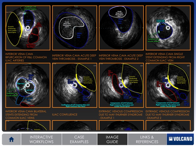 Venous IVUS(圖5)-速報App