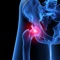 Differentiating between a transient synovitis (irritable hip) and septic arthritis of the hip is a common but difficult task faced by emergency physicians and paediatricians on a daily basis