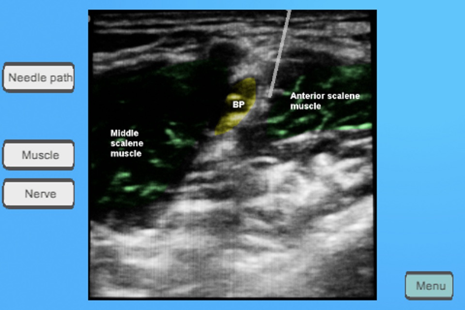 Regional Anesthesia Assistant for iPhone screenshot 3