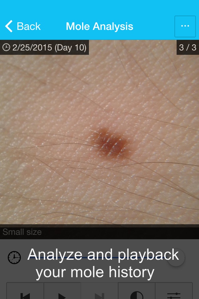 Skin Cancer App - MySkinPal - Map your skin moles screenshot 3