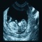 The program contains 778 flashcards that will help you study and pass the ARDMS OB/GYN boards to become a Registered Diagnostic Medical Sonographer