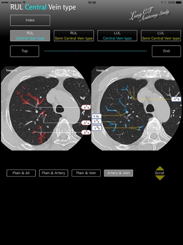 Lung CT Anatomy STUDY screenshot 3
