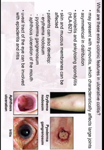 AnswersIn Ulcerative Colitis screenshot 3