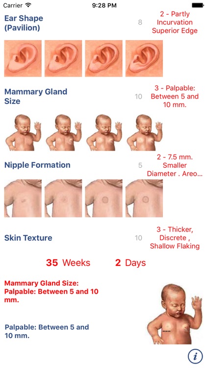 Neonatology: Test Capurro