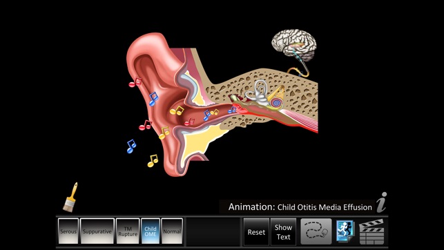 Otitis Media Disorders(圖3)-速報App